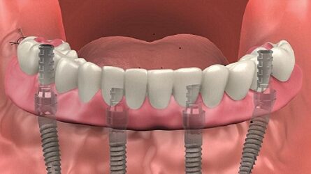 all in 4 dental implants