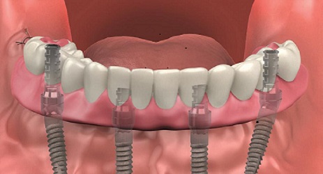 What Are The Advantages Of All-In-4 Dental Implants?