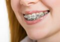 clear braces with color bands