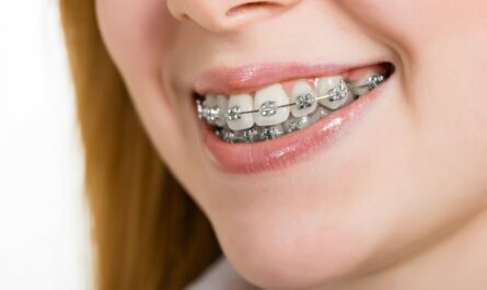 clear braces with color bands