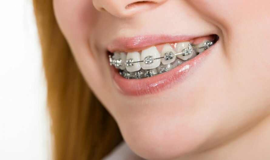 What Are the Advantages of Dark Purple Braces with Clear