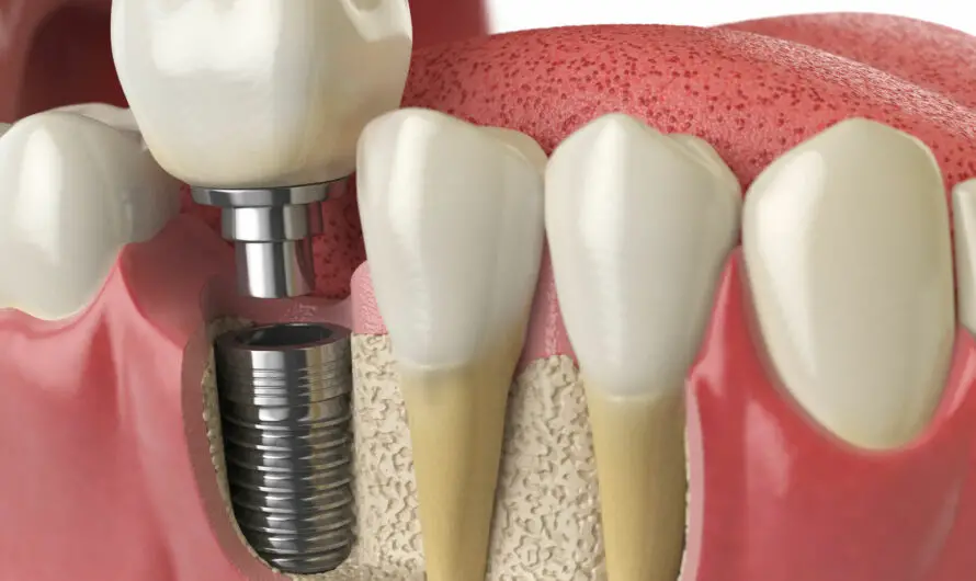 Advantage: Why Choose a Dental Implant Specialist for Your?