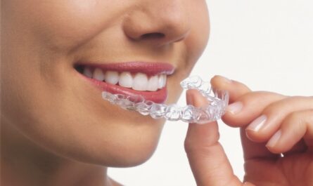 invisalign express before and after