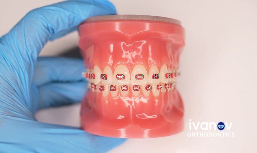 What Are The Cutest Braces Colors For A Vibrant Smile?